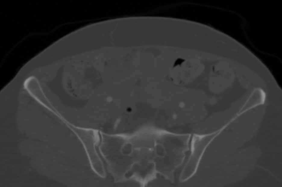 Axial CTA slice through the lower abdomen in greyscale, showing subcutaneous fat, bowel, and the iliac bones, with no annotation.