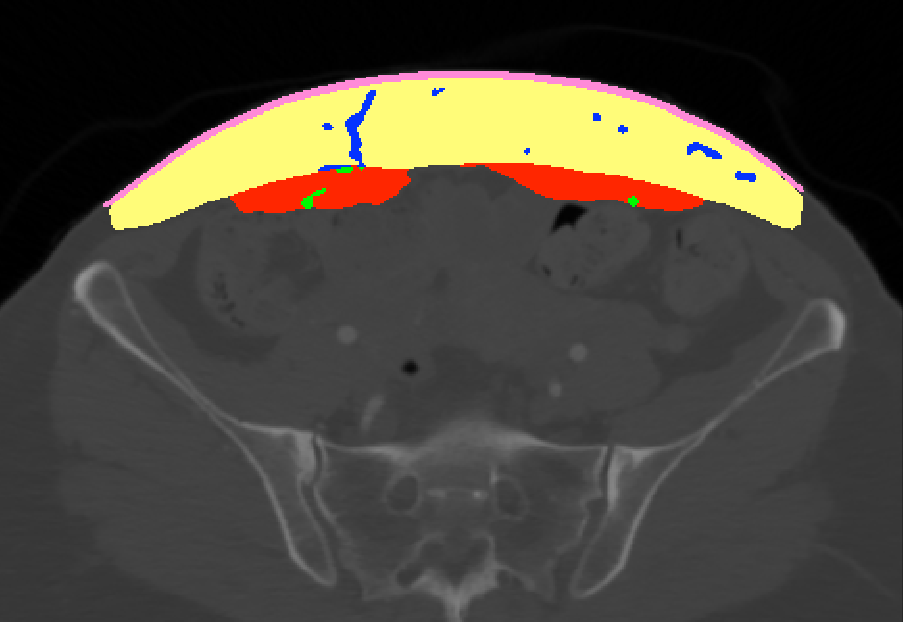 The same axial CTA slice with the automatic six-class overlay: yellow subcutaneous fat, red rectus abdominis muscle, blue vessels threading through the fat, a thin pink skin layer, and small green perforation points at the muscle boundary.