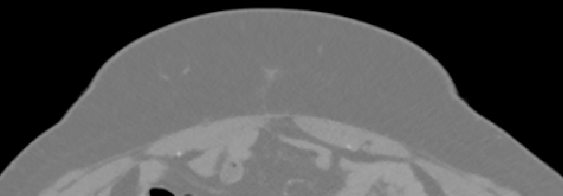 Zoomed axial CTA of the anterior abdominal wall. The subcutaneous fat appears as a broad uniform grey band, with only a few tiny bright dots and a faint thread within it marking perforating vessels.