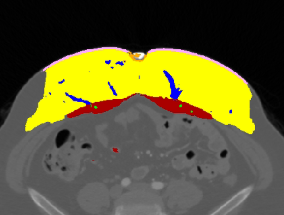 Axial CTA slice of the lower abdomen with an automatic colour overlay: a thick yellow band of subcutaneous fat, a dark red rectus abdominis muscle beneath it, blue perforating vessels threading up through the fat, a thin pink skin layer, an orange umbilicus and small green markers at the perforation points.