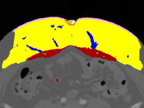 Axial CTA slice of the abdominal wall with an automatic colour overlay marking subcutaneous fat, rectus abdominis muscle, perforating vessels and the perforation points