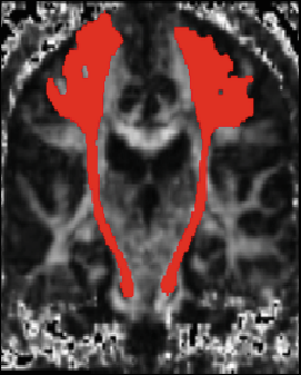 Coronal fractional-anisotropy brain slice with the bilateral motor tract highlighted in red, segmented automatically from a 16-direction diffusion scan
