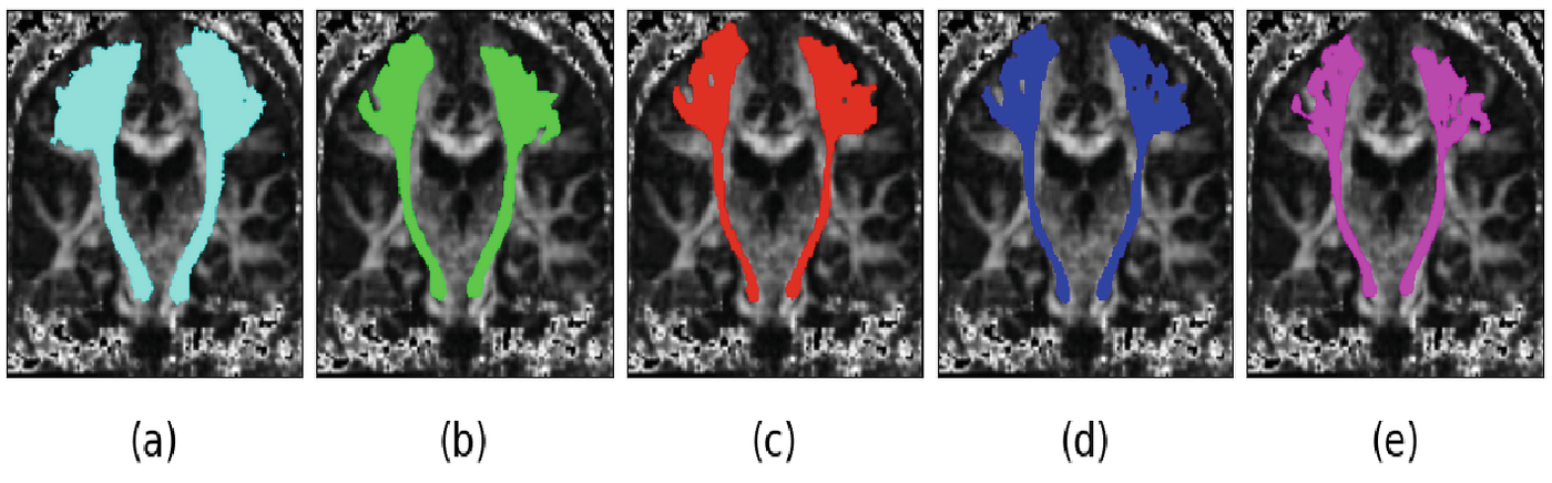 Five coronal fractional-anisotropy slices side by side, each overlaid with a bilateral motor tract in a different colour: cyan, green, red, blue and magenta. The first four show a full, smooth, symmetric pair of tracts; the last is visibly thinner and more ragged.