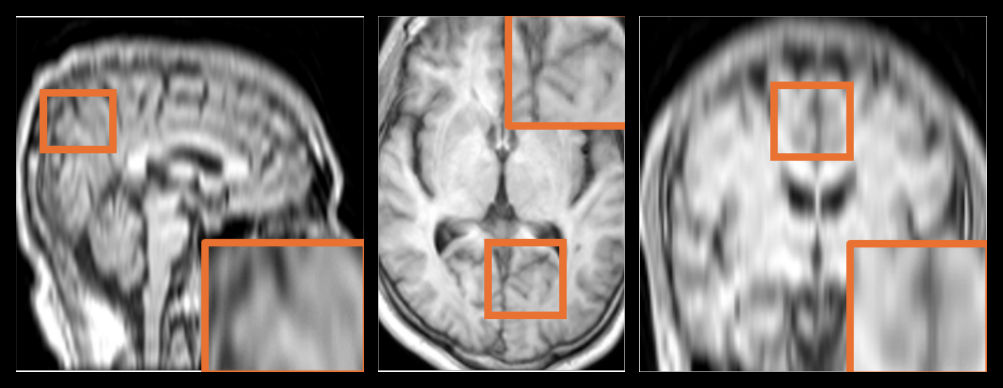 The same accelerated brain scan in sagittal, axial and coronal views before refinement, each blurred, with orange boxes marking magnified detail regions
