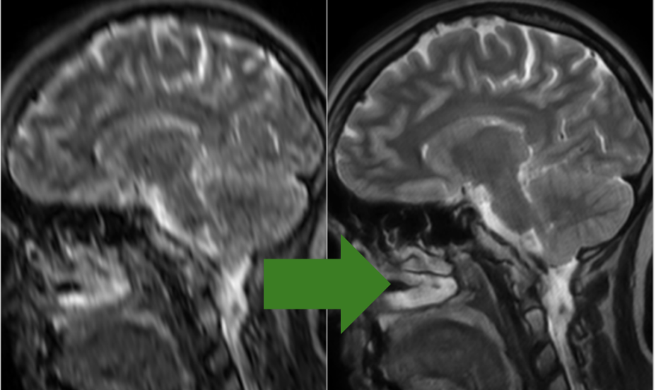 Two sagittal brain MRI slices side by side: a blurred scan from an accelerated acquisition, and an arrow pointing to the sharp reconstruction recovered from it