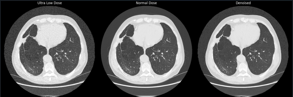 Axial chest CT slice shown three ways: ultra-low dose (noisy), normal dose, and the AI-denoised ultra-low dose result matching normal-dose quality