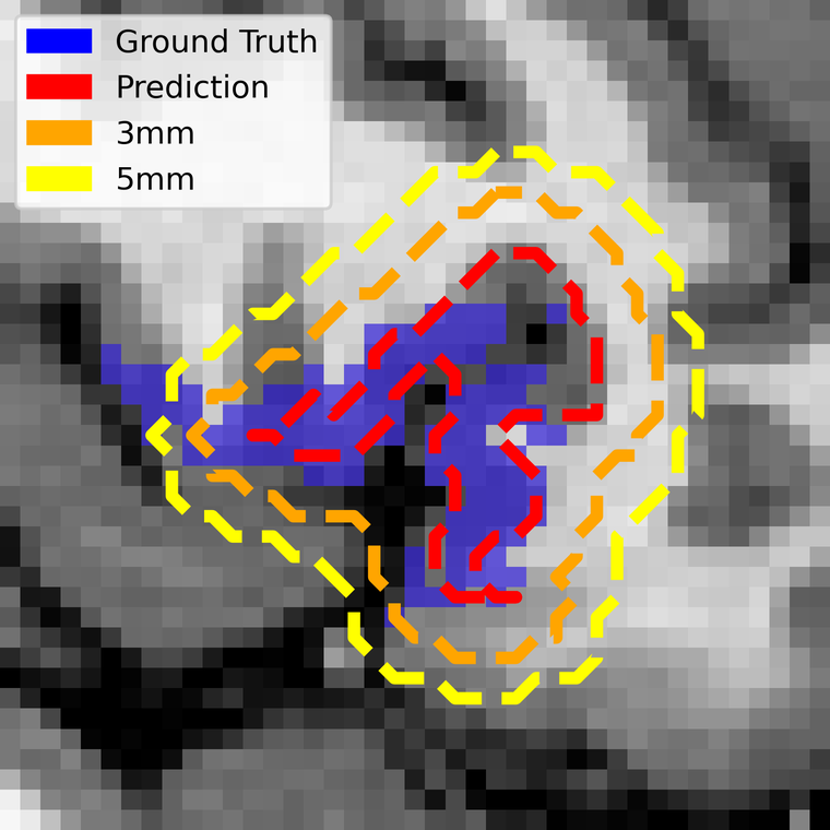 Zoomed grayscale MRI of the Broca region. The fMRI ground truth is a solid blue patch, the prediction a red dashed contour, and its 3 mm and 5 mm expansions are orange and yellow dashed contours which together enclose essentially all of the blue.