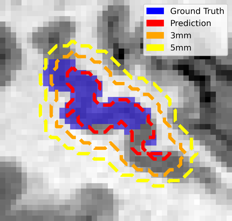 Zoomed grayscale MRI of the Wernicke region, with the blue ground truth patch enclosed by the red prediction contour and its orange 3 mm and yellow 5 mm expansions.