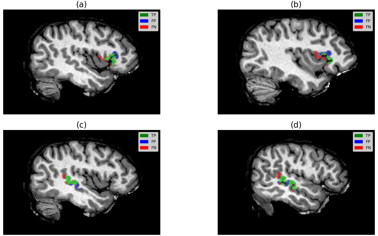 Four sagittal T1-weighted brain slices arranged in a two-by-two grid. Each shows a small cluster of coloured voxels near the language areas: green for true positives, blue for false positives and red for false negatives, with the clusters tightly grouped in anatomically plausible locations.