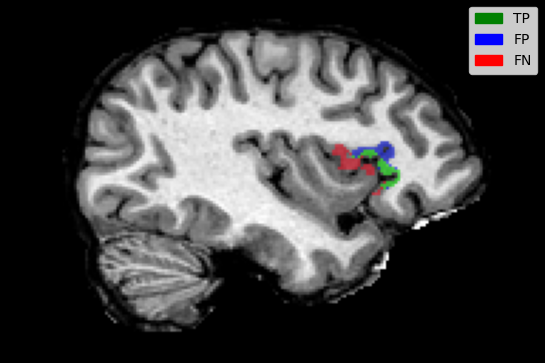 Sagittal brain MRI slice with a small cluster of green, blue and red voxels marking the predicted language area against the fMRI ground truth