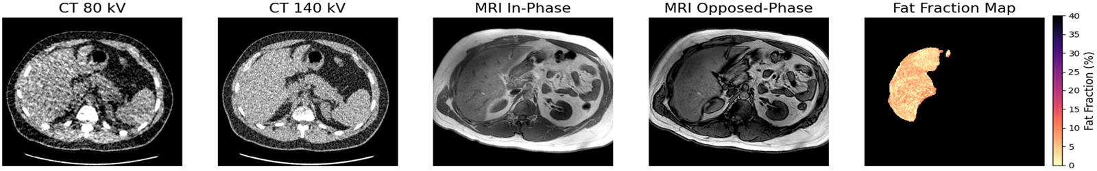 Five registered axial slices from one subject: CT at 80 kV, CT at 140 kV, MRI in-phase, MRI opposed-phase, and the derived fat fraction map shown as a colour overlay on the liver with a 0–40% scale.