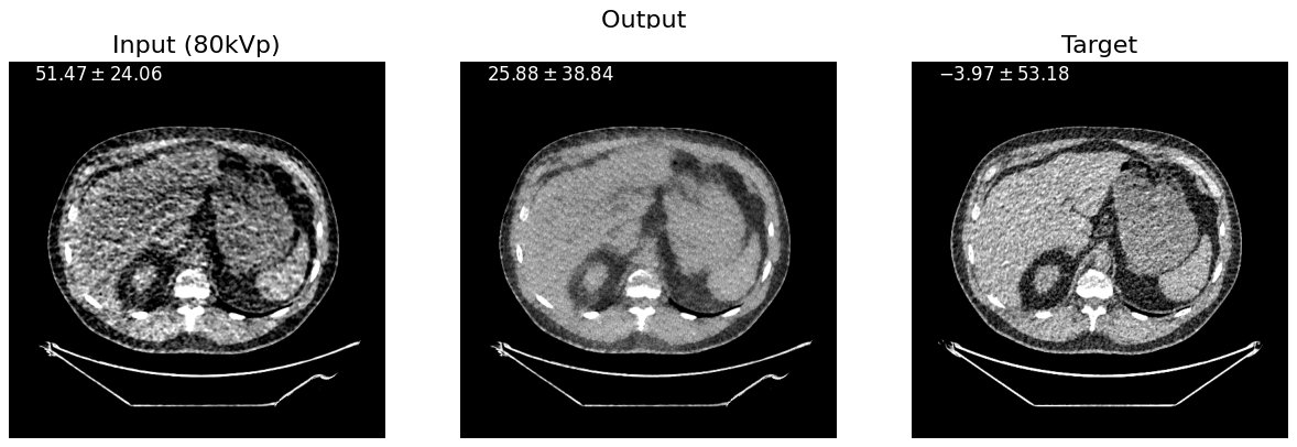 Three axial abdominal CT slices side by side: the grainy 80 kVp input, the much smoother denoised output, and the 140 kVp target, which retains moderate noise.