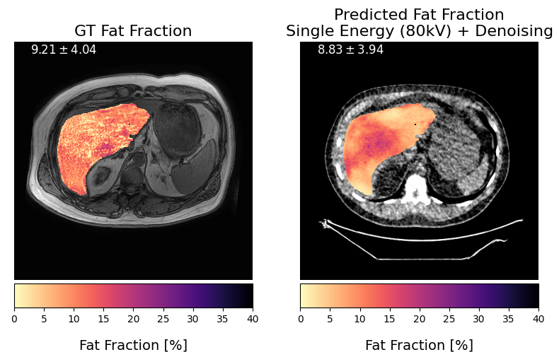 Four panels for one case: MRI ground-truth fat fraction overlay reading 9.21 ± 4.04, the predicted fat fraction from 80 kVp plus denoising reading 8.83 ± 3.94, and two CT scans in HU with the liver overlaid.