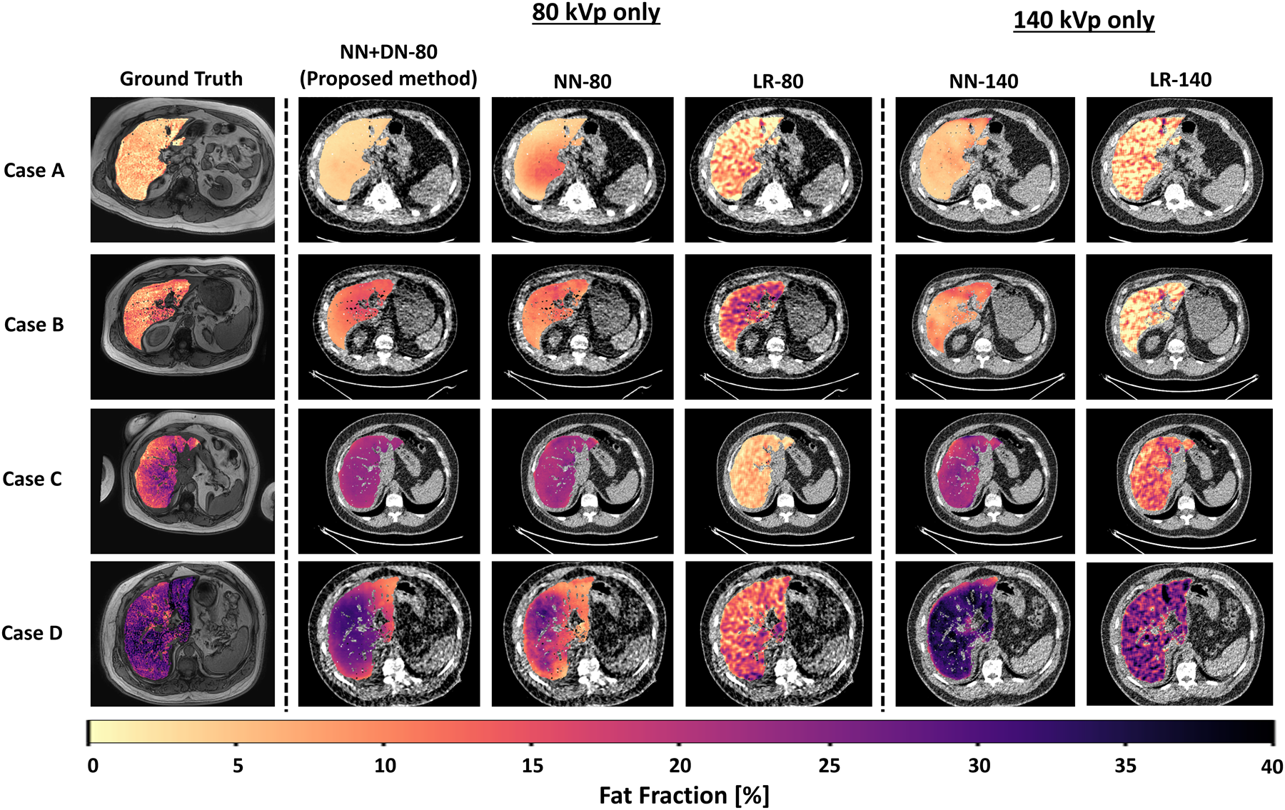 Grid of four test cases. Each row shows the MRI-derived ground-truth fat fraction map, then predictions from the proposed NN+DN-80 model, NN-80, LR-80 (all from 80 kVp input) and NN-140, LR-140 (from 140 kVp input). The proposed method closely matches the ground truth while the linear regression maps are visibly noisy.