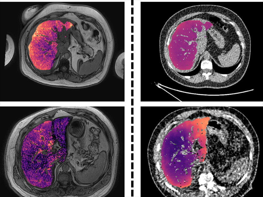 MRI-derived ground truth liver fat fraction maps beside maps predicted from ultra-low dose CT
