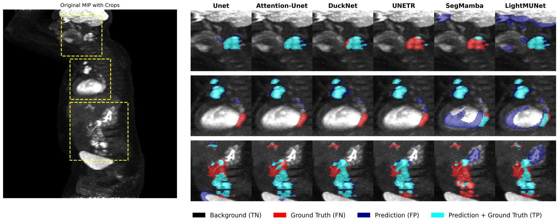 On the left, a whole-body PET maximum intensity projection with three yellow dashed boxes marking regions containing tumours. On the right, a grid comparing six architectures across those three regions; the CNN models show mostly cyan true-positive overlap, while SegMamba and LightMUNet add large dark-blue false-positive regions over bright organs.