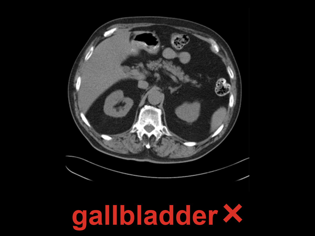 An unaltered abdominal CT slice labelled in red with the word gallbladder and a cross — the organ the model affirmed, which has zero label voxels on this slice
