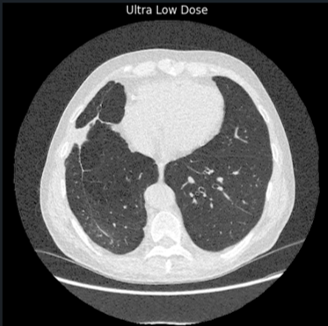 Ultra-low dose chest CT slice
